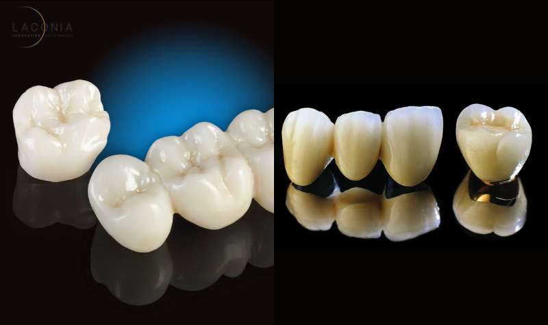 Răng toàn sứ và răng sứ Titan
