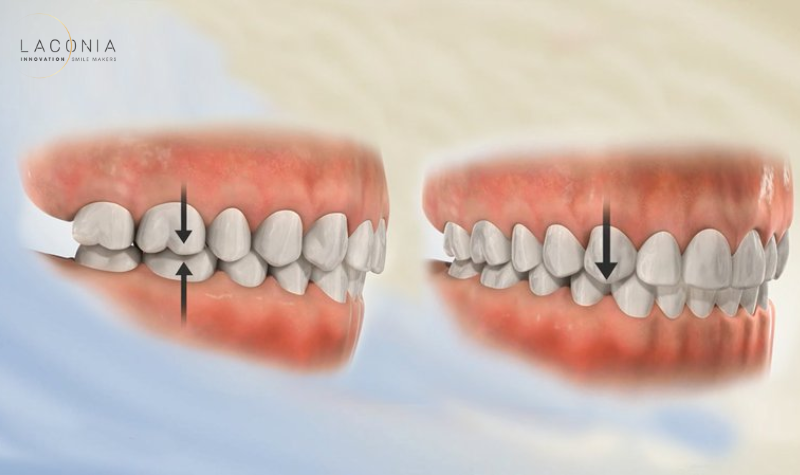 Bọc răng sứ bị lệch khớp cắn